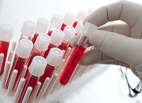 blood test for the diagnosis of arthritis and arthrosis