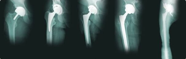 options for hip replacement in arthrosis