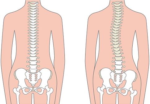 Low back pain due to spinal deformity such as scoliosis