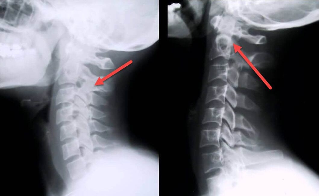 Manifestations of osteochondrosis of the cervical spine on x-ray