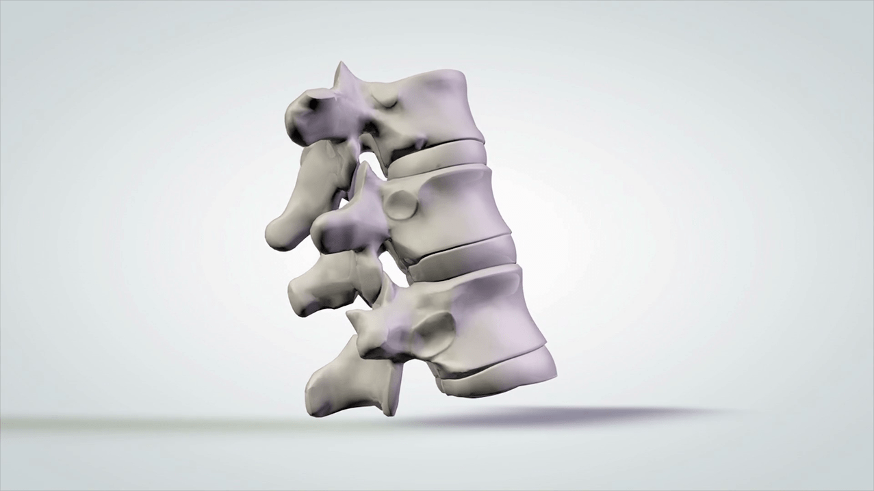 damage to the spine due to cervical osteochondrosis