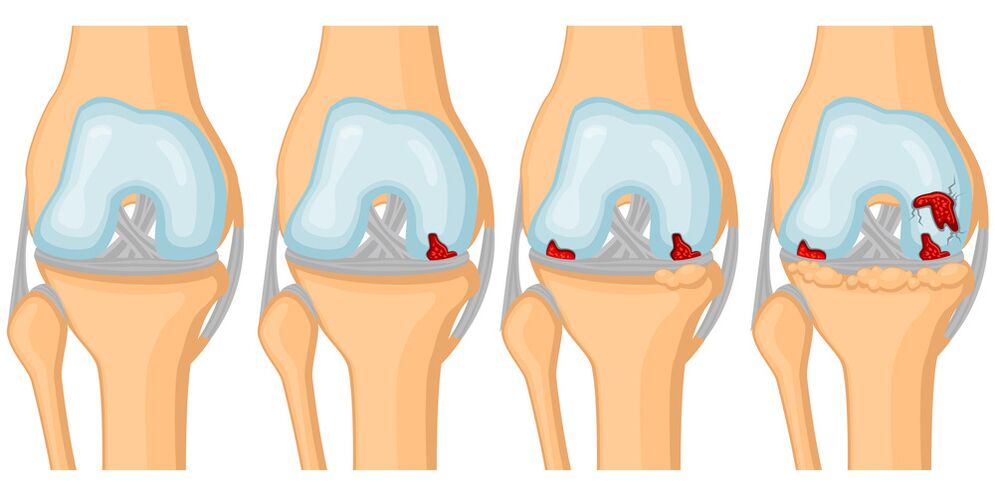 Degree of development of joint arthrosis